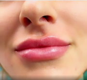 Lip Fillers in Nottingham