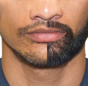 Get The Best Beard Transplant UK