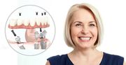 Affordable Dental Implants – From £78/M