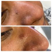 Skin tag removal clinic Goodmayes 