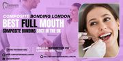 Composite Bonding London – Best Full Mouth Composite Bonding Cost in t